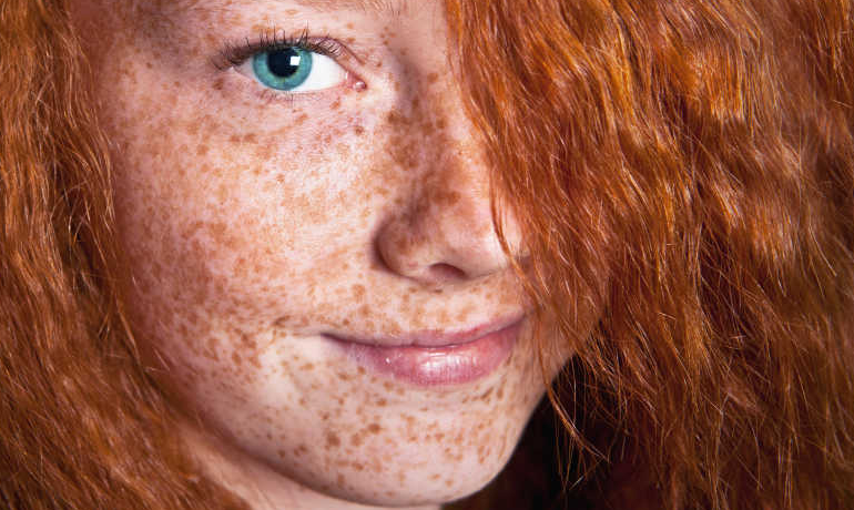 告别雀斑！五种有效淡化方法让你美白肌肤