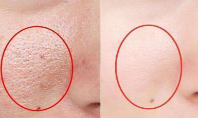 毛孔粗大的烦恼？这些解决办法你知道吗！